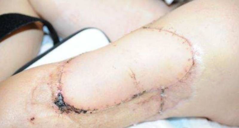 Paddle boarder bitten by shark in Canary Islands